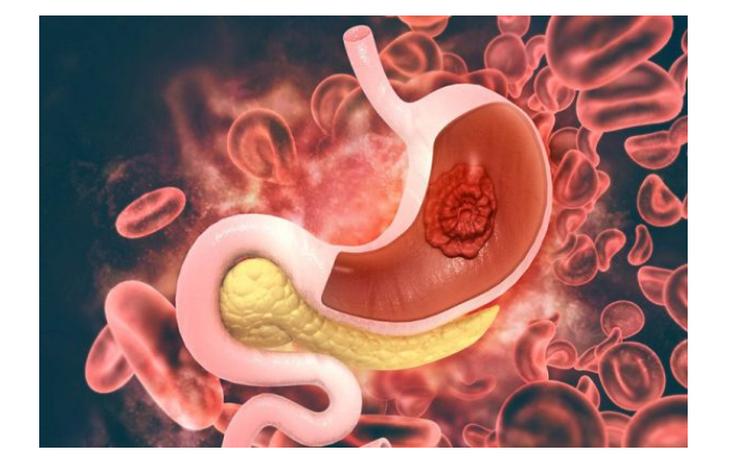 Viêm loét dạ dày – thậm chí khi không lạm dụng rượu bia- Ảnh 1.