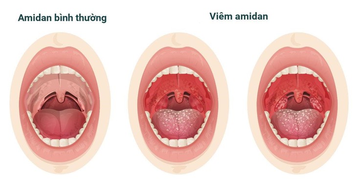 5 triệu chứng viêm amidan thường gặp và cách cải thiện- Ảnh 1.