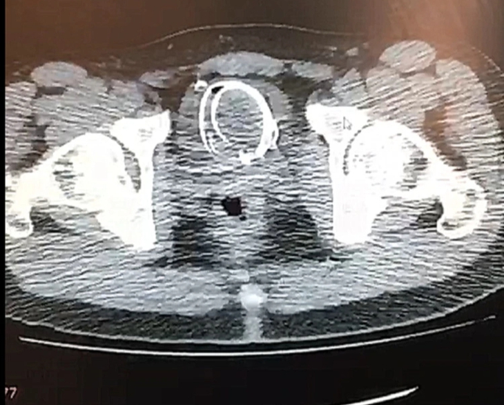 Tá hỏa với cành cây, dây chuyền, lưỡi câu, bàn chải trong niệu đạo- Ảnh 2. Tá hỏa với cành cây, dây chuyền, lưỡi câu, bàn chải trong niệu đạo- Ảnh 2.
