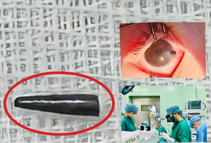Bé 9 tháng tuổi bị ruột bút chì đâm thủng nhãn cầu- Ảnh 1.