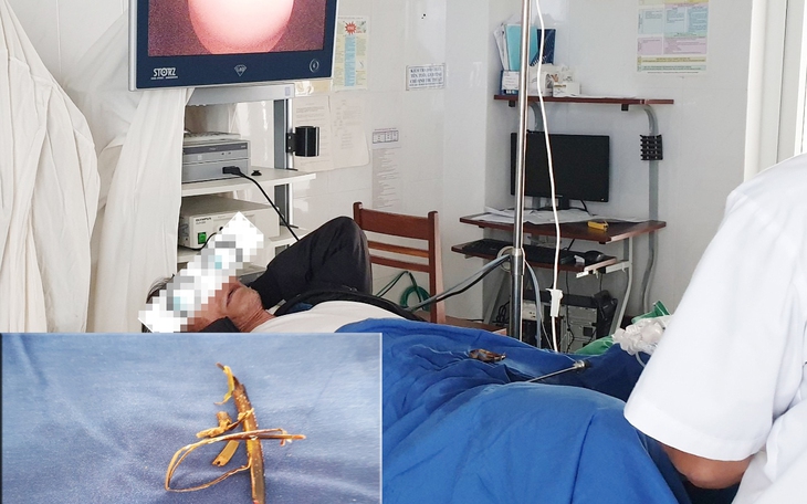Dùng cành cà phê khô gãi niệu đạo, bệnh nhân phải nhập viện với dị vật dài 10cm