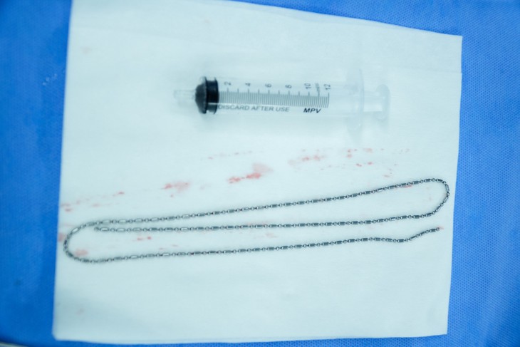 Tá hỏa với cành cây, dây chuyền, lưỡi câu, bàn chải trong niệu đạo- Ảnh 1. Tá hỏa với cành cây, dây chuyền, lưỡi câu, bàn chải trong niệu đạo- Ảnh 1.