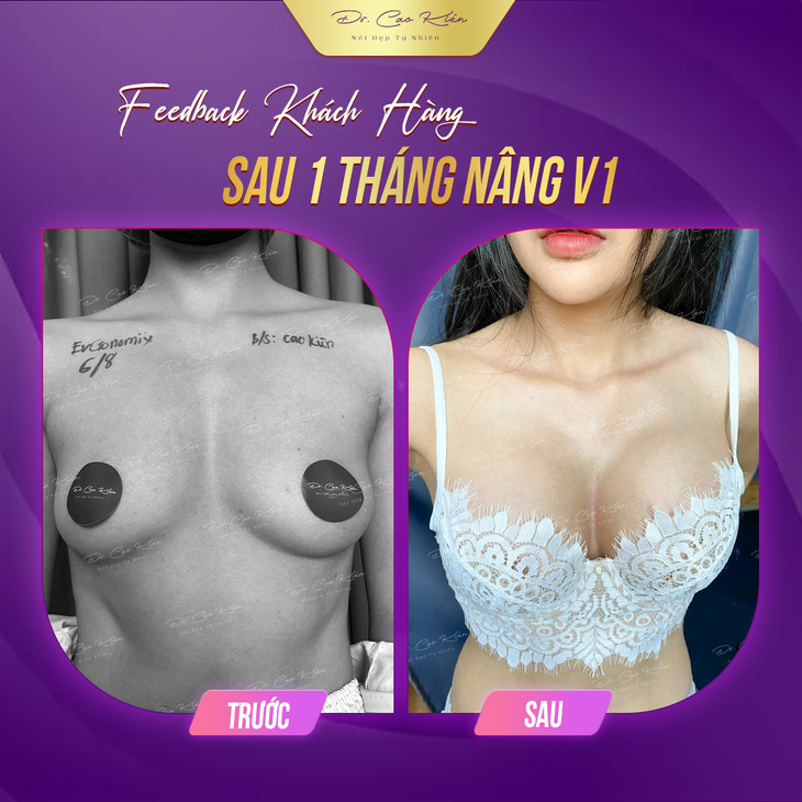 Nâng ngực – Những tiết lộ ít biết từ chuyên gia thẩm mỹ- Ảnh 3.