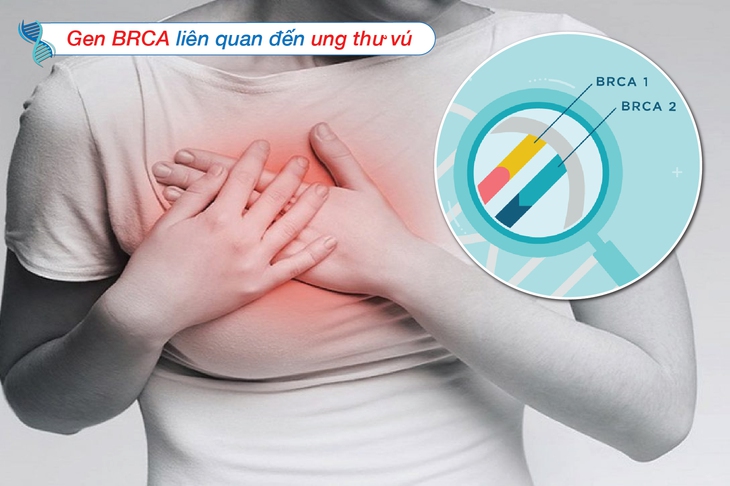 Nên được tư vấn bắt đầu sàng lọc ung thư vú ở độ tuổi trẻ hơn và thường xuyên hơn, nên chụp X-quang tuyến vú hàng năm, bắt đầu từ tuổi 25 đến 35. Ảnh minh họa Nên được tư vấn bắt đầu sàng lọc ung thư vú ở độ tuổi trẻ hơn và thường xuyên hơn, nên chụp X-quang tuyến vú hàng năm, bắt đầu từ tuổi 25 đến 35. Ảnh minh họa