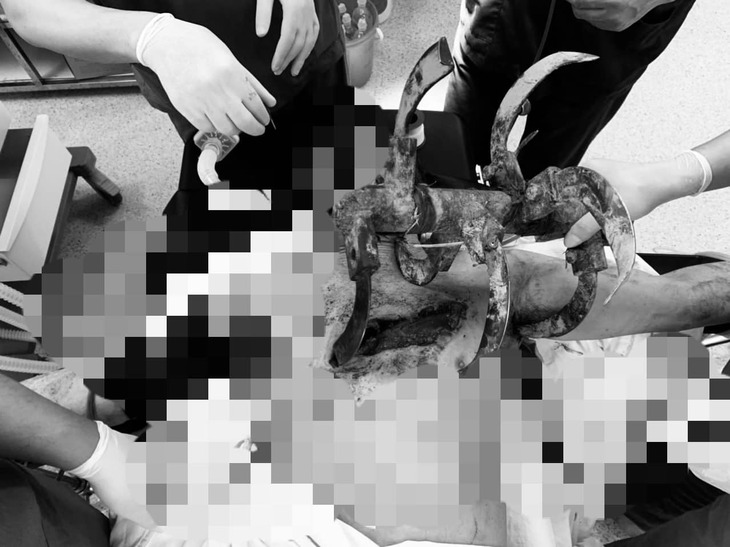 Tai nạn kinh hoàng, người nông dân nhập viện với lưỡi cày cắm sâu vào ngực- Ảnh 2.