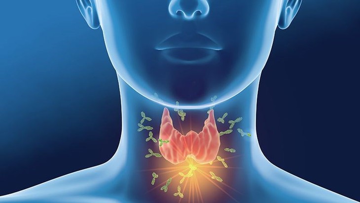Suy giáp là bệnh lý tuyến giáp hoạt động kém hiệu quả, sản xuất hormon không đủ nhu cầu của cơ thể.
