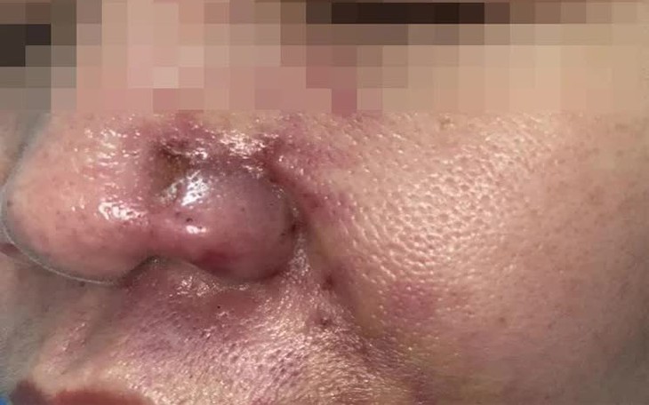 Tắc mạch sau tiêm filler làm đẹp mũi má ở nhà người quen