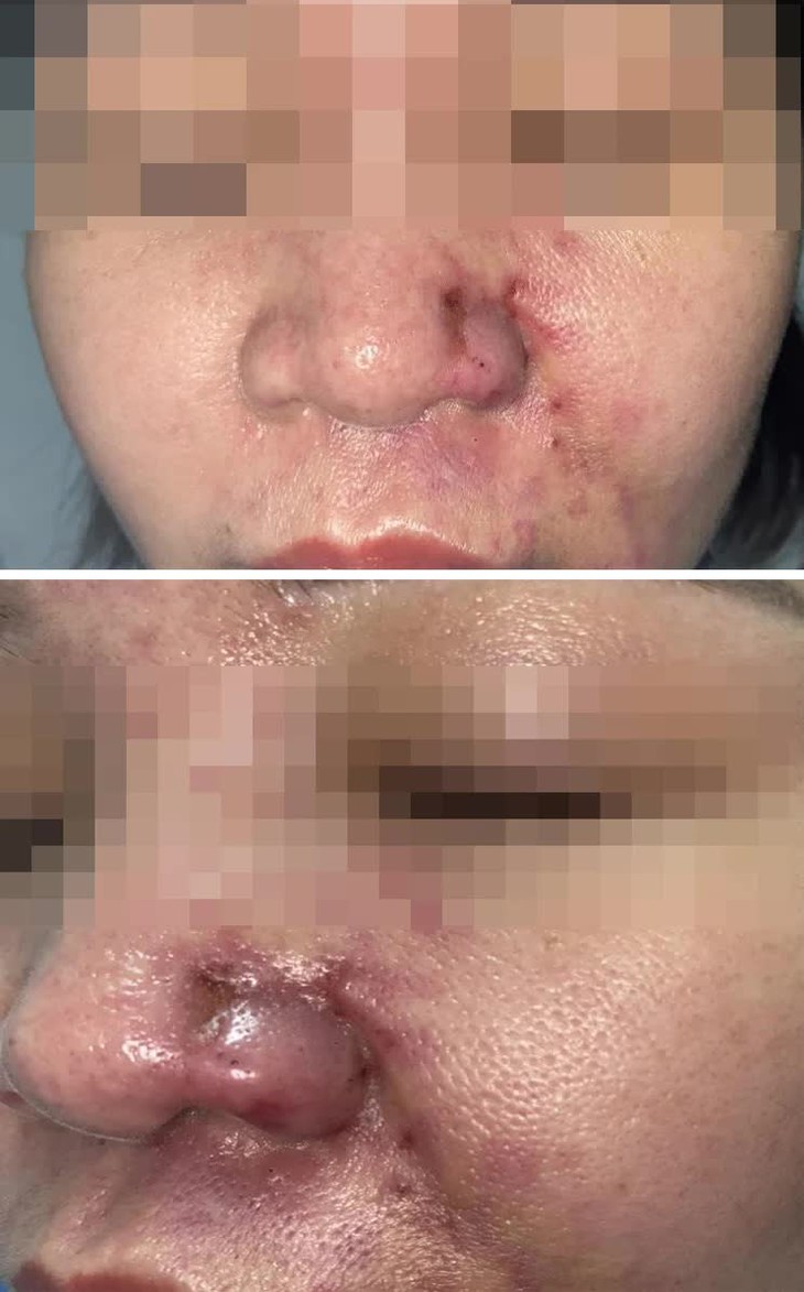 Tắc mạch sau tiêm filler làm đẹp mũi má ở nhà người quen- Ảnh 1. Tắc mạch sau tiêm filler làm đẹp mũi má ở nhà người quen- Ảnh 1.