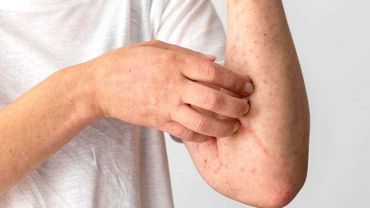 Dấu hiệu cảnh báo men gan tăng- Ảnh 1. Dấu hiệu cảnh báo men gan tăng- Ảnh 1.
