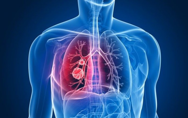 Đau xương khớp kéo dài, cảnh giác với ung thư phổi di căn