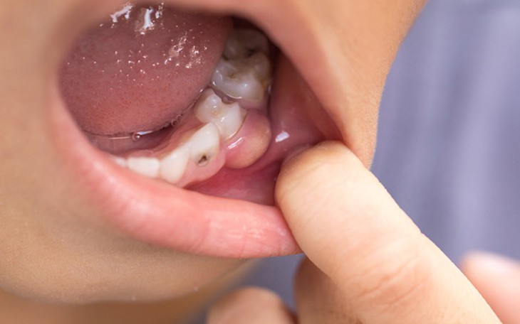 Viêm lợi sau khi bọc răng sứ phải làm gì?- Ảnh 1.