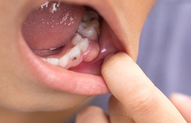 Những thói quen gây viêm lợi ít người biết- Ảnh 1. Những thói quen gây viêm lợi ít người biết- Ảnh 1.