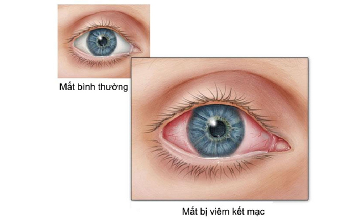 Điều trị bệnh viêm kết mạc cấp và mạn tính trong y học cổ truyền- Ảnh 2.