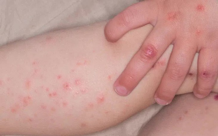 Sở Y tế Hà Nội cảnh báo cao điểm dịch tay chân miệng 