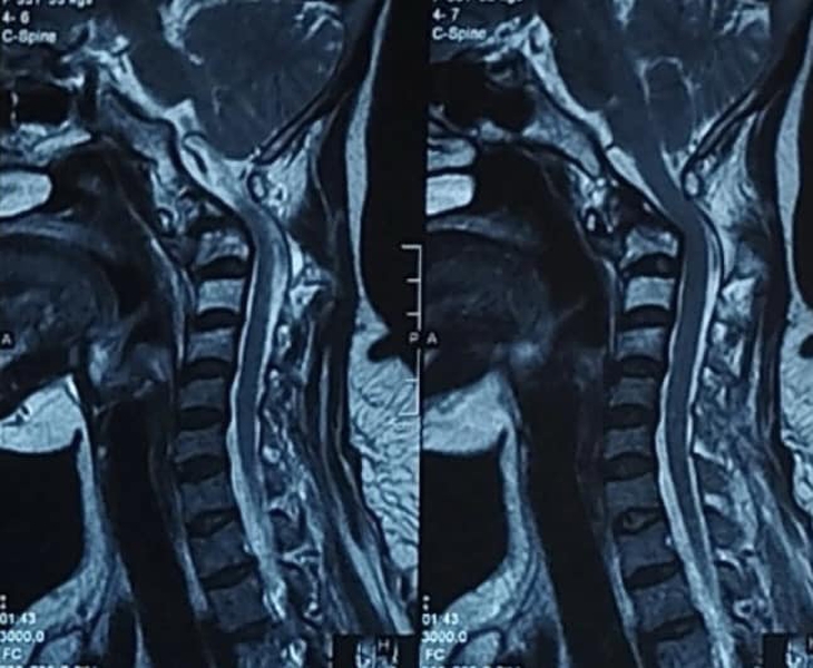 Bệnh nhân ung thư phổi di căn thoát liệt nhờ bác sĩ quyết thực hiện ca phẫu thuật khó- Ảnh 1.