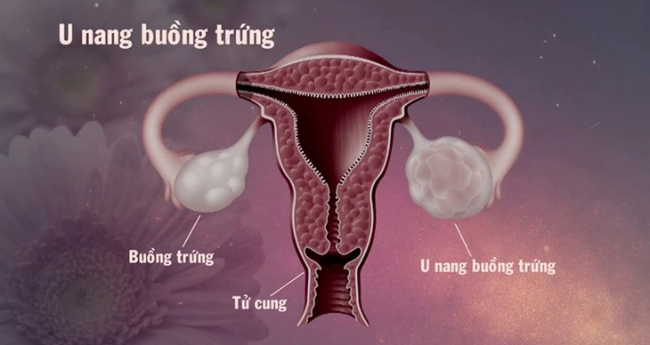 Hoa đu đủ đực ngâm mật ong có chữa được bệnh u nang buồng trứng?- Ảnh 4.
