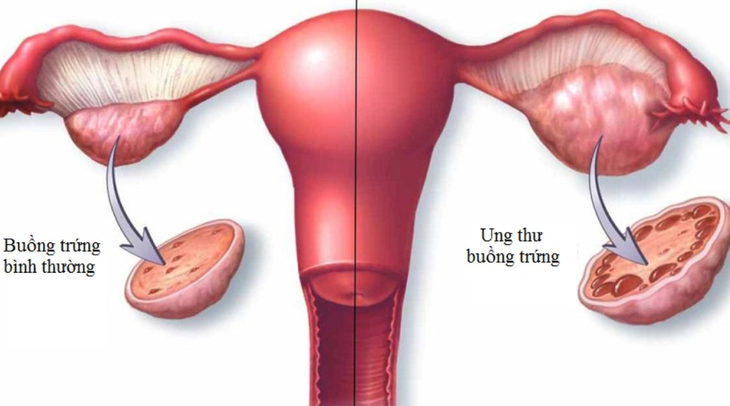 Câu hỏi thường gặp liên quan đến ung thư buồng trứng- Ảnh 1.