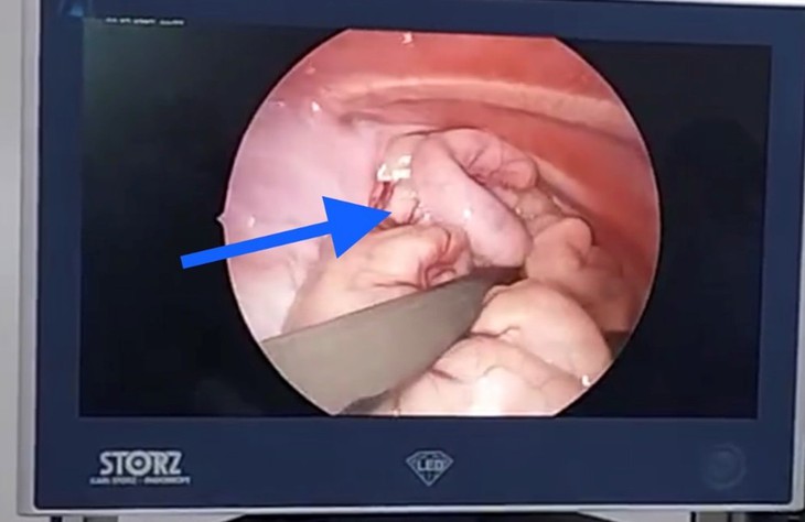 Bệnh viện Trẻ em Hải Phòng phẫu thuật nội soi điều trị thoát vị cơ hoành bẩm sinh hiếm gặp cho bệnh nhi 16 tháng tuổi- Ảnh 2.