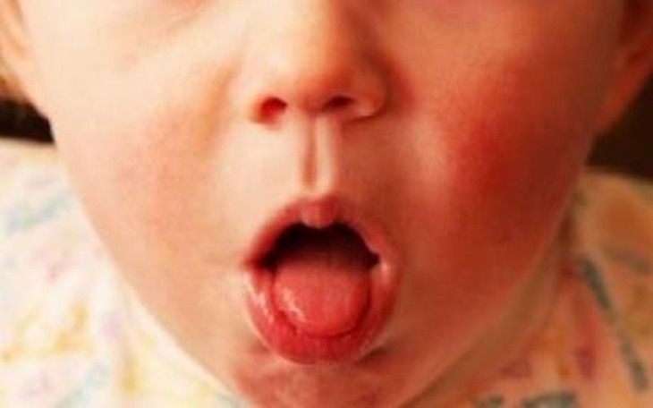 Bé gái 2 tháng tuổi mắc ho gà diễn biến nặng