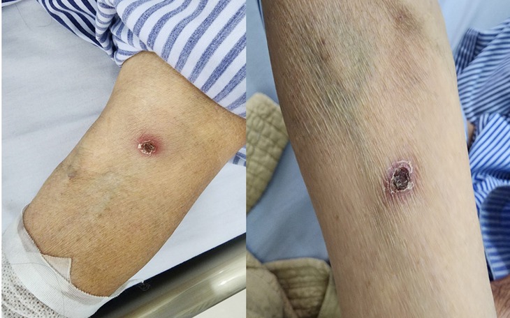 Cụ bà nguy kịch sau cơn sốt cao, rét run, nguyên nhân chỉ từ một vết đốt