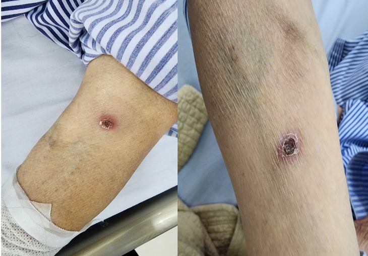Cụ bà nguy kịch sau cơn sốt cao, rét run, nguyên nhân chỉ từ một vết đốt- Ảnh 2.