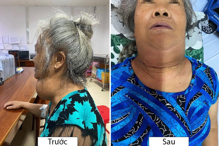 Phẫu thuật thành công bệnh nhân có bướu tuyến giáp khổng lồ- Ảnh 1.