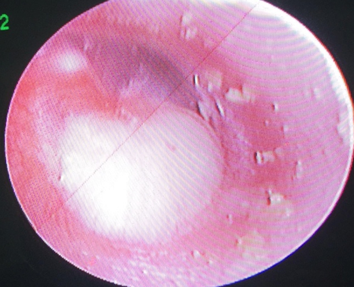 Bệnh Cholesteatoma bẩm sinh tai giữa và cách điều trị- Ảnh 2.