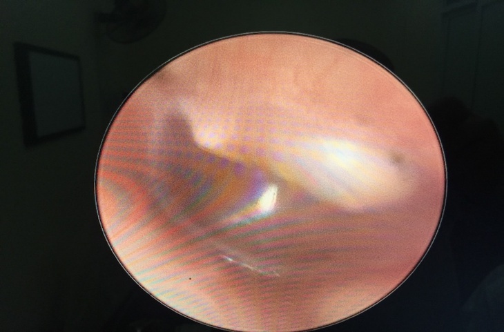 Bệnh Cholesteatoma bẩm sinh tai giữa và cách điều trị- Ảnh 3.