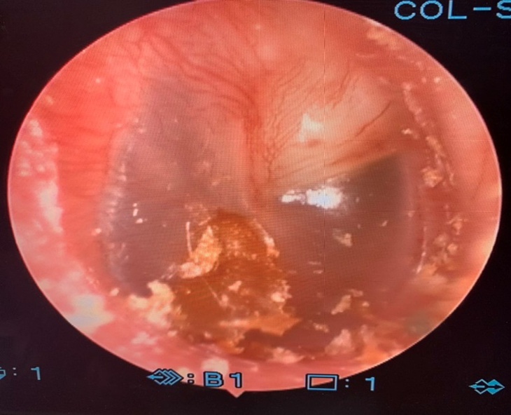 Bệnh Cholesteatoma bẩm sinh tai giữa và cách điều trị- Ảnh 4.