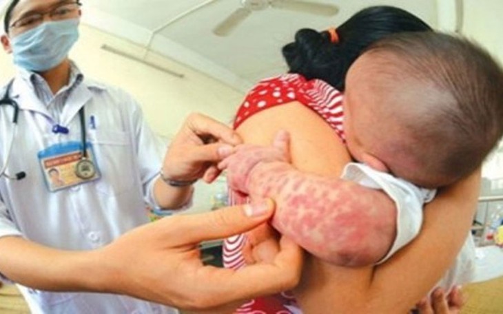 Ca mắc sởi, ho gà, thủy đậu... tăng, Bộ Y tế yêu cầu quyết liệt phòng, chống dịch dịp nghỉ lễ 30/4 và 1/5