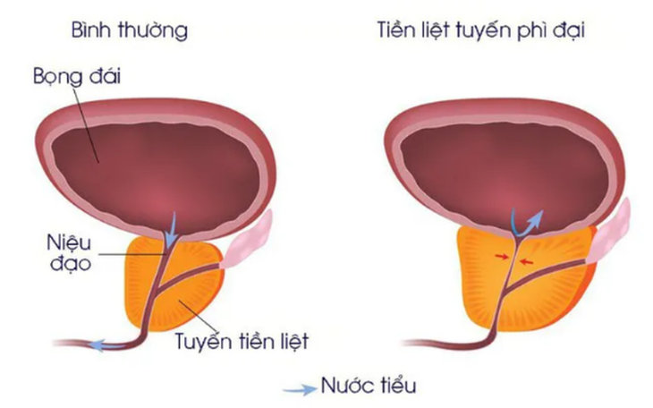 Phì đại tiền liệt tuyến: Nguyên nhân, triệu chứng, điều trị và cách phòng ngừa- Ảnh 1. Phì đại tiền liệt tuyến: Nguyên nhân, triệu chứng, điều trị và cách phòng ngừa- Ảnh 1.