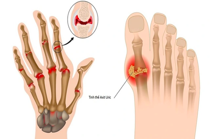 5 cách đào thải axit uric nhanh khỏi cơ thể cần biết- Ảnh 1. 5 cách đào thải axit uric nhanh khỏi cơ thể cần biết- Ảnh 1.