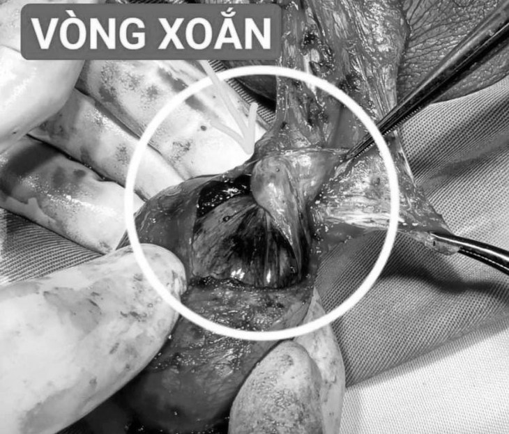 Nhiều trẻ phải cắt bỏ tinh hoàn vì đến viện muộn, cha mẹ lưu ý dấu hiệu dưới đây- Ảnh 2.