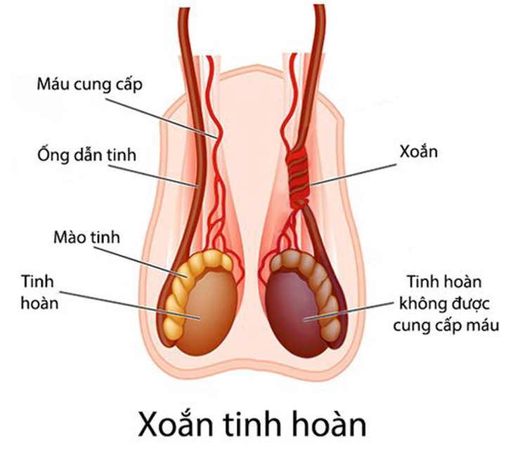 Nhiều trẻ phải cắt bỏ tinh hoàn vì đến viện muộn, cha mẹ lưu ý dấu hiệu dưới đây- Ảnh 3.