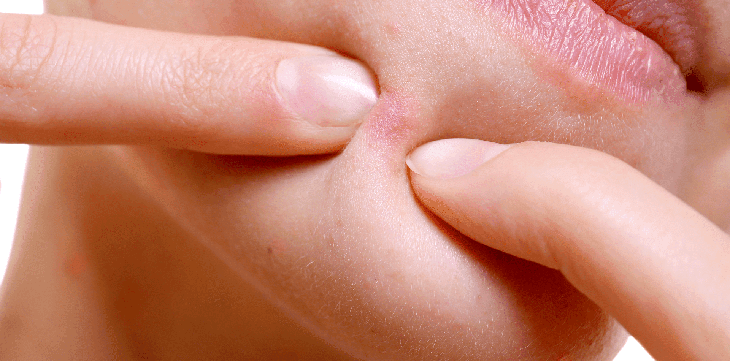 Tác hại khi nặn mụn không đúng cách- Ảnh 1.