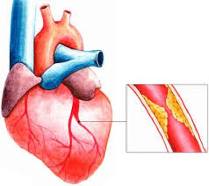 Câu hỏi thường gặp liên quan đến nhồi máu cơ tim cấp- Ảnh 1. Câu hỏi thường gặp liên quan đến nhồi máu cơ tim cấp- Ảnh 1.