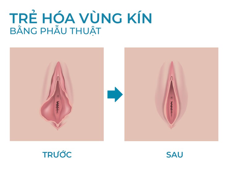 Trẻ hoá vùng kín bằng phẫu thuật: Thu hẹp âm đạo và tạo hình môi bé- Ảnh 1.
