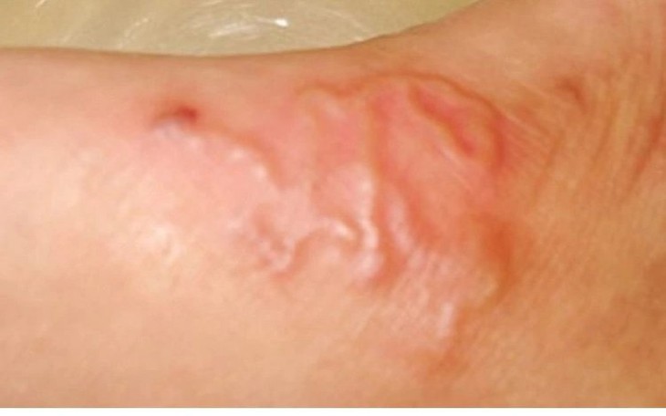 Mỗi năm khoảng 20.000 người ở nước ta phải điều trị do nhiễm giun sán lây từ 