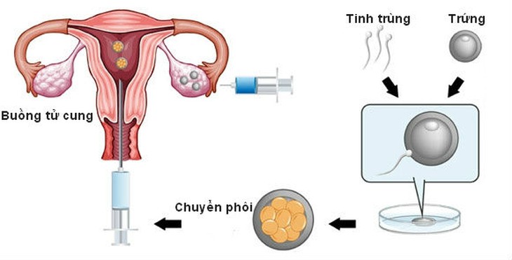 Sự khác biệt giữa thụ tinh trong tử cung và thụ tinh trong ống nghiệm- Ảnh 2.