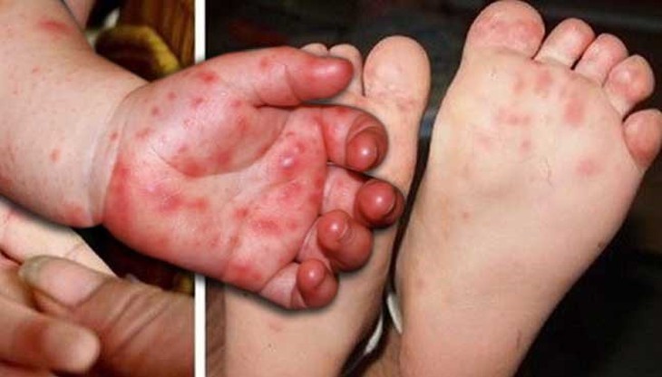 Những triệu chứng của bệnh tay chân miệng ở trẻ- Ảnh 1.