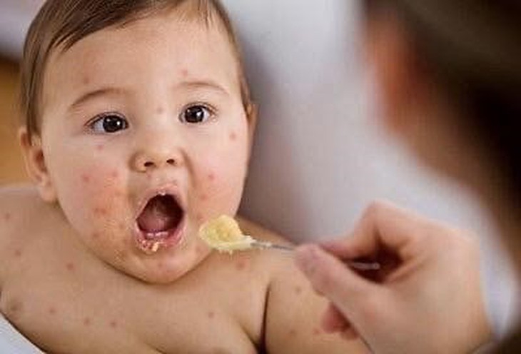 Những triệu chứng của bệnh tay chân miệng ở trẻ- Ảnh 2.