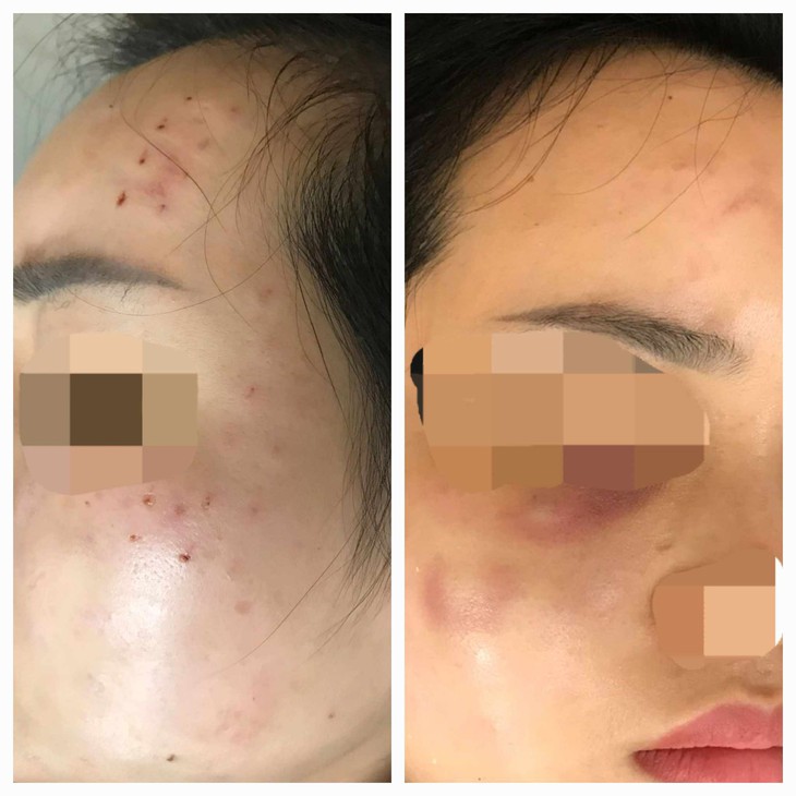 Chủ cơ sở spa tiêm 'nhầm' sữa rửa mặt vào da cho khách- Ảnh 1.