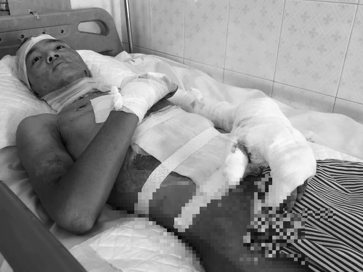 Bị bỏng điện cao thế, người đàn ông dân tộc liệt hai chân, lo lắng khi điều trị không có bảo hiểm y tế- Ảnh 1. Bị bỏng điện cao thế, người đàn ông dân tộc liệt hai chân, lo lắng khi điều trị không có bảo hiểm y tế- Ảnh 1.