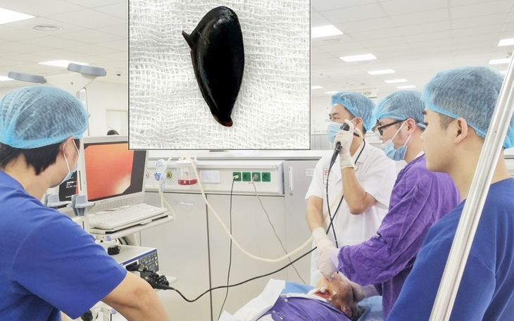 Cấp cứu thành công bệnh nhân 90 tuổi bị hóc hạt hồng xiêm