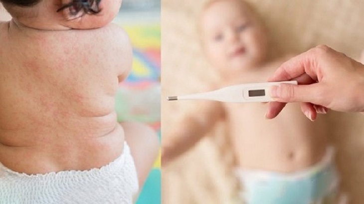 Cách phát hiện sớm sốt phát ban ở trẻ- Ảnh 1. Cách phát hiện sớm sốt phát ban ở trẻ- Ảnh 1.