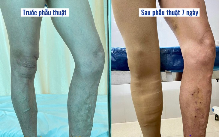 Tĩnh mạch chi dưới có thể gây ra những biến chứng nguy hiểm gì?- Ảnh 4.