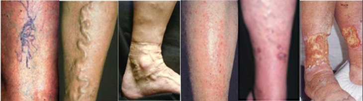 Huyết khối tĩnh mạch sâu: Nguyên nhân, triệu chứng, cách phòng ngừa và điều trị- Ảnh 3.