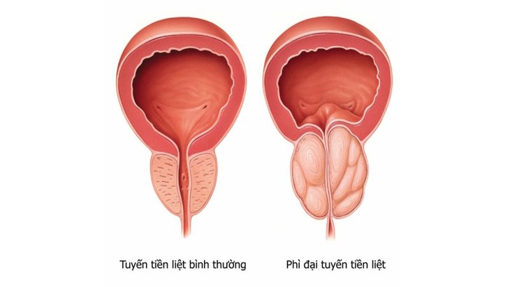 Ung thư tuyến tiền liệt: Nguyên nhân, biểu hiện, cách điều trị và phòng bệnh- Ảnh 1. Ung thư tuyến tiền liệt: Nguyên nhân, biểu hiện, cách điều trị và phòng bệnh- Ảnh 1.