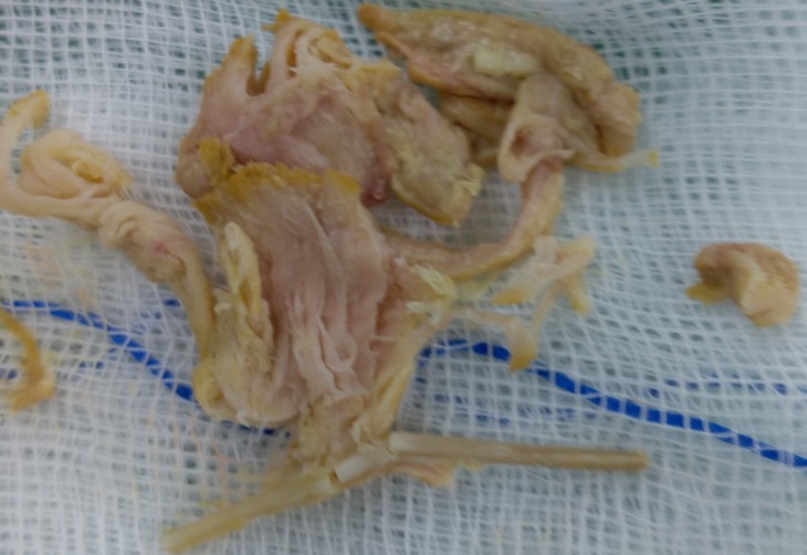 Hội chẩn nhiều chuyên khoa gắp xương gà nằm sâu trong thực quản cụ ông- Ảnh 1. Hội chẩn nhiều chuyên khoa gắp xương gà nằm sâu trong thực quản cụ ông- Ảnh 1.
