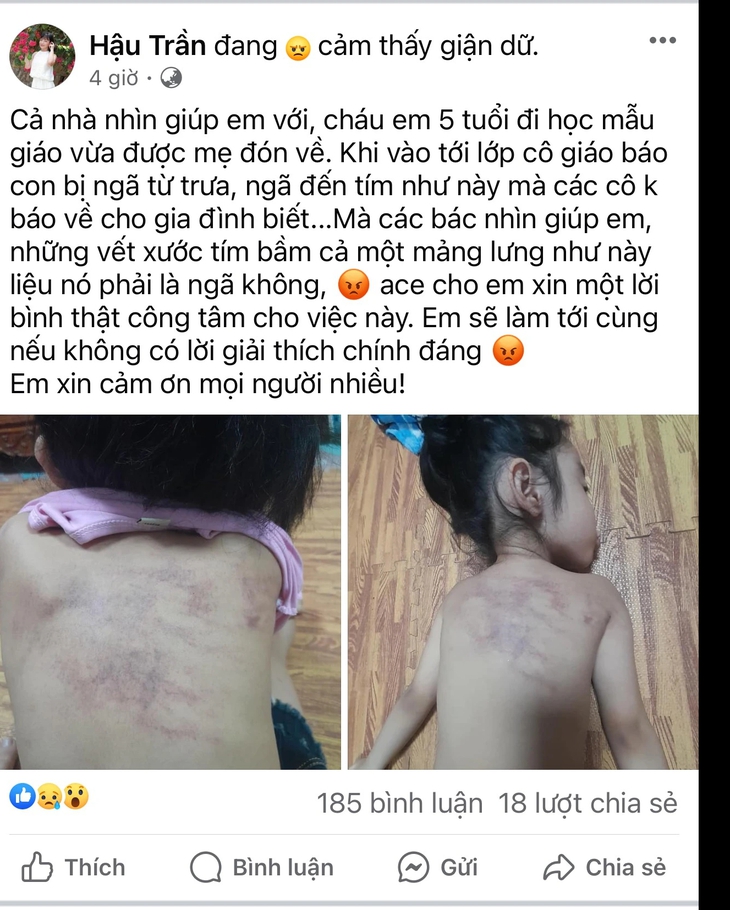 Bé gái 5 tuổi nghi bị bạo hành ở trường, Chủ tịch TP. Hải Phòng yêu cầu làm rõ- Ảnh 1. Bé gái 5 tuổi nghi bị bạo hành ở trường, Chủ tịch TP. Hải Phòng yêu cầu làm rõ- Ảnh 1.